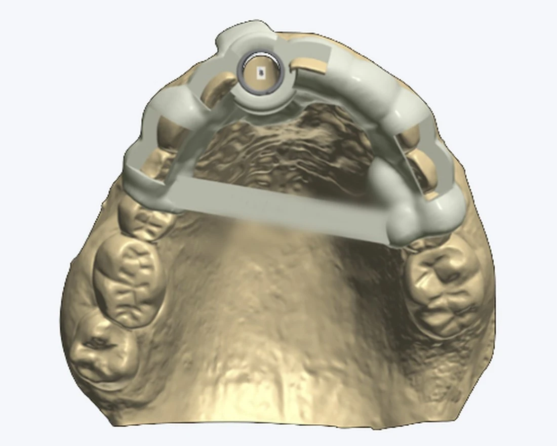 A surgical guide seated on the upper teeth that remain, carrying a single drill sleeve over the tooth being replaced, braced across the palate