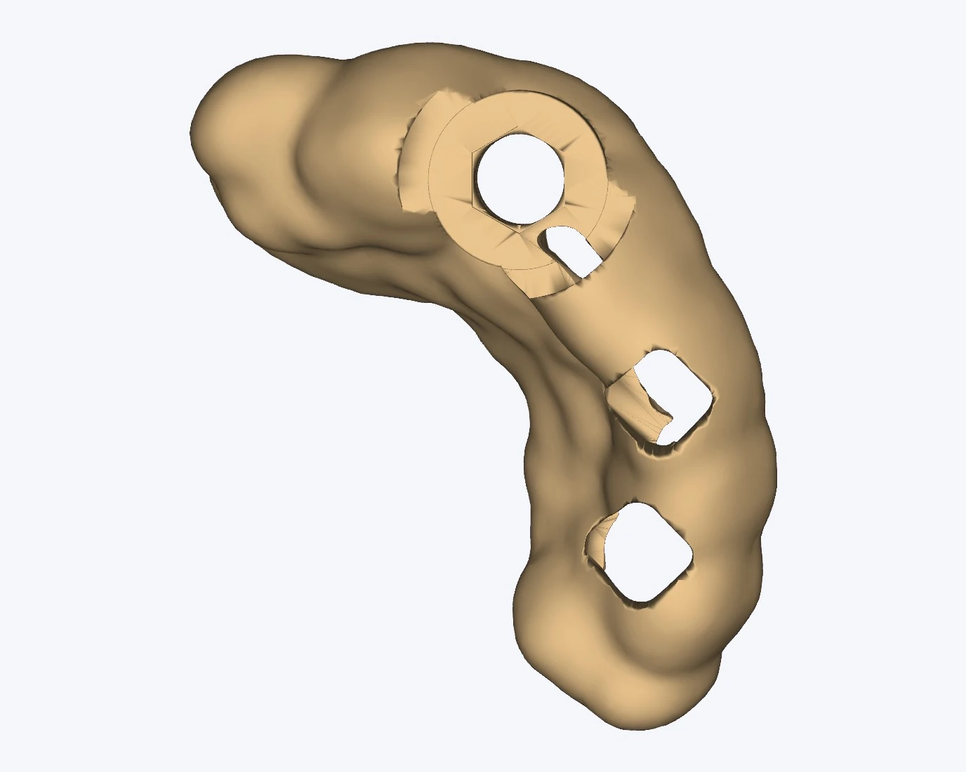 A tooth-supported surgical guide for a single unit: one drill sleeve over the gap and two windows that show the guide is fully seated on the teeth beside it