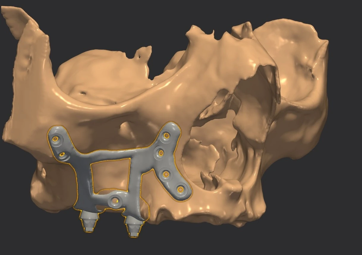 The framework seated on the maxilla, its outline following the bone
