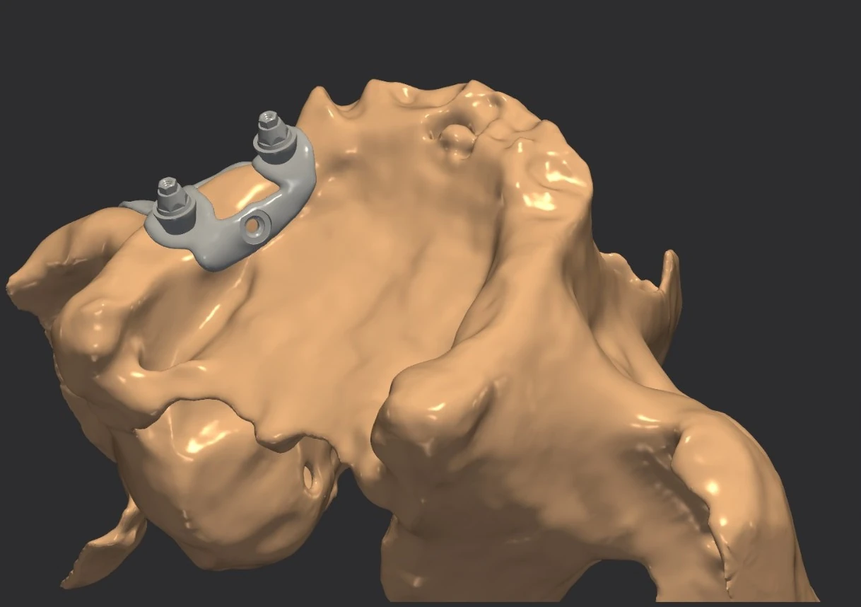 The framework brought down onto the bone it was designed from