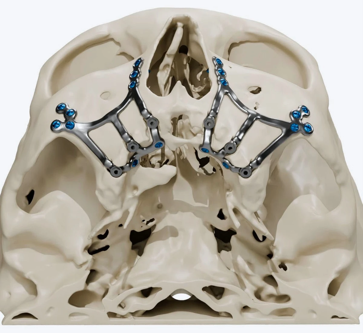 Patient-specific titanium subperiosteal frameworks fixed with screws to both sides of the midface