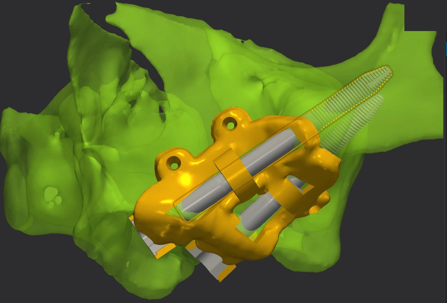 The plan open in Implant 3D: the segmented bone, the guide seated on it, and the zygomatic trajectory running to the zygomatic body